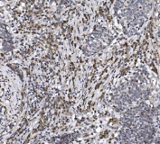 IHC staining of FFPE human lung cancer with NAF-1 antibody. HIER: boil tissue sections in pH8 EDTA for 20 min and allow to cool before testing.