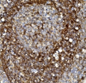 IHC staining of FFPE human lung cancer with Claudin 1 antibody. HIER: boil tissue sections in pH8 EDTA for 20 min and allow to cool before testing.