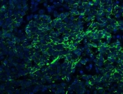 Immunofluorescent staining of FFPE human lung cancer with Claudin 1 antibody (green) and DAPI nuclear stain (blue). HIER: steam section in pH8 EDTA for 20 min.