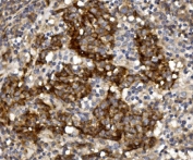 IHC staining of FFPE human lung cancer with Claudin 1 antibody. HIER: boil tissue sections in pH8 EDTA for 20 min and allow to cool before testing.