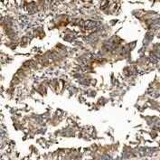 IHC staining of FFPE human rectal cancer with Claudin 1 antibody. HIER: boil tissue sections in pH8 EDTA for 20 min and allow to cool before testing.