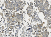 IHC staining of FFPE human pancreatic cancer with CLDN3 antibody. HIER: boil tissue sections in pH8 EDTA for 20 min and allow to cool before testing.