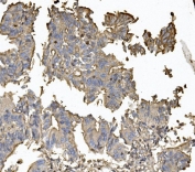 IHC staining of FFPE human rectal cancer with CLDN5 antibody. HIER: boil tissue sections in pH8 EDTA for 20 min and allow to cool before testing.
