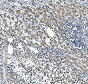 IHC staining of FFPE human liver cancer tissue with CYP7A1 antibody. HIER: boil tissue sections in pH8 EDTA for 20 min and allow to cool before testing.