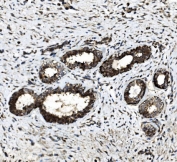 IHC staining of FFPE human breast cancer with DDX6 antibody. HIER: boil tissue sections in pH8 EDTA for 20 min and allow to cool before testing.