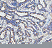 IHC staining of FFPE human stomach cancer with DDX6 antibody. HIER: boil tissue sections in pH8 EDTA for 20 min and allow to cool before testing.
