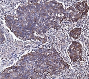 IHC staining of FFPE human lung cancer with EGF Receptor antibody. HIER: boil tissue sections in pH8 EDTA for 20 min and allow to cool before testing.