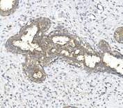 IHC staining of FFPE human breast cancer with Galactosidase alpha antibody. HIER: boil tissue sections in pH8 EDTA for 20 min and allow to cool before testing.