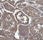 IHC staining of FFPE human liver cancer tissue with GRB10 antibody. HIER: boil tissue sections in pH8 EDTA for 20 min and allow to cool before testing.