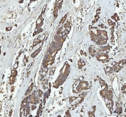 IHC staining of FFPE human colorectal adenocarcinoma tissue with GRB10 antibody. HIER: boil tissue sections in pH8 EDTA for 20 min and allow to cool before testing.