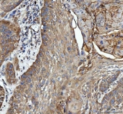 IHC staining of FFPE human laryngeal squamous cell carcinoma tissue with GRB10 antibody. HIER: boil tissue sections in pH8 EDTA for 20 min and allow to cool before testing.