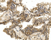 IHC staining of FFPE human renal cancer with GRB14 antibody. HIER: boil tissue sections in pH8 EDTA for 20 min and allow to cool before testing.