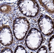 IHC staining of FFPE human rectal cancer with HIF1A antibody. HIER: boil tissue sections in pH8 EDTA for 20 min and allow to cool before testing.