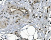 IHC staining of FFPE human breast cancer with JUNB antibody. HIER: boil tissue sections in pH8 EDTA for 20 min and allow to cool before testing.