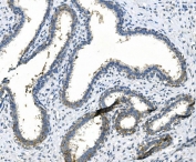 IHC staining of FFPE human breast cancer with LPP antibody. HIER: boil tissue sections in pH8 EDTA for 20 min and allow to cool before testing.