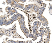 IHC staining of FFPE human rectal cancer with LPP antibody. HIER: boil tissue sections in pH8 EDTA for 20 min and allow to cool before testing.