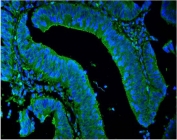 Immunofluorescent staining of FFPE human intestinal cancer with LPP antibody (green) and DAPI nuclear stain (blue). HIER: steam section in pH8 EDTA for 20 min.