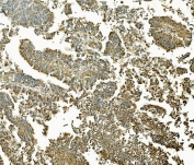 IHC staining of FFPE human rectal cancer with MAP2K2 antibody. HIER: boil tissue sections in pH8 EDTA for 20 min and allow to cool before testing.