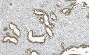 IHC staining of FFPE human breast cancer with MAPK7 antibody. HIER: boil tissue sections in pH8 EDTA for 20 min and allow to cool before testing.