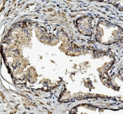 IHC staining of FFPE human prostate cancer with MMP2 antibody. HIER: boil tissue sections in pH8 EDTA for 20 min and allow to cool before testing.