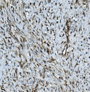 IHC staining of FFPE human breast cancer with MMP2 antibody. HIER: boil tissue sections in pH8 EDTA for 20 min and allow to cool before testing.