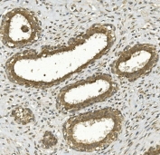 IHC staining of FFPE human breast cancer with NRF-2 antibody. HIER: boil tissue sections in pH8 EDTA for 20 min and allow to cool before testing.