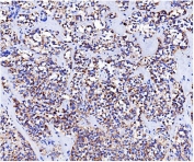 IHC staining of FFPE human pancreatic cancer with NOX5 antibody. HIER: boil tissue sections in pH8 EDTA for 20 min and allow to cool before testing.