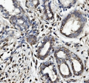 IHC staining of FFPE human breast cancer with OCLN antibody. HIER: boil tissue sections in pH8 EDTA for 20 min and allow to cool before testing.