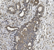IHC staining of FFPE human breast cancer with PHB2 antibody. HIER: boil tissue sections in pH8 EDTA for 20 min and allow to cool before testing.