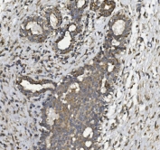 IHC staining of FFPE human breast cancer with PHB2 antibody. HIER: boil tissue sections in pH8 EDTA for 20 min and allow to cool before testing.