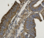 IHC staining of FFPE human rectal cancer with PHB2 antibody. HIER: boil tissue sections in pH8 EDTA for 20 min and allow to cool before testing.