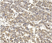 IHC staining of FFPE human breast cancer with PI3K gamma antibody. HIER: boil tissue sections in pH8 EDTA for 20 min and allow to cool before testing.