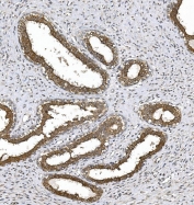 IHC staining of FFPE human breast cancer with PKC theta antibody. HIER: boil tissue sections in pH8 EDTA for 20 min and allow to cool before testing.