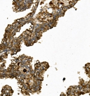 IHC staining of FFPE human renal cancer with Renin antibody. HIER: boil tissue sections in pH8 EDTA for 20 min and allow to cool before testing.