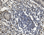 IHC staining of FFPE human rectal cancer with SAMHD1 antibody. HIER: boil tissue sections in pH8 EDTA for 20 min and allow to cool before testing.