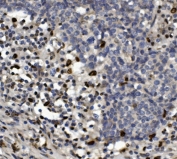 IHC staining of FFPE human lung cancer with SAMHD1 antibody. HIER: boil tissue sections in pH8 EDTA for 20 min and allow to cool before testing.