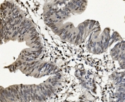 IHC staining of FFPE human rectal cancer with SAMHD1 antibody. HIER: boil tissue sections in pH8 EDTA for 20 min and allow to cool before testing.