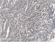 IHC staining of FFPE human meningoma tissue with SHANK3 antibody. HIER: boil tissue sections in pH8 EDTA for 20 min and allow to cool before testing.