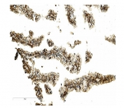 IHC staining of FFPE human renal cancer with MST-2 antibody. HIER: boil tissue sections in pH8 EDTA for 20 min and allow to cool before testing.