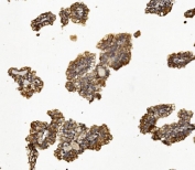 IHC staining of FFPE human renal cancer with SYNPO antibody. HIER: boil tissue sections in pH8 EDTA for 20 min and allow to cool before testing.
