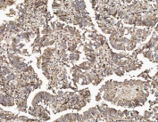 IHC staining of FFPE human rectal cancer with TAB2 antibody. HIER: boil tissue sections in pH8 EDTA for 20 min and allow to cool before testing.