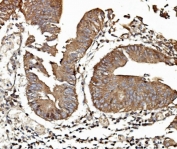 IHC staining of FFPE human rectal cancer with TAB2 antibody. HIER: boil tissue sections in pH8 EDTA for 20 min and allow to cool before testing.