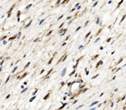 IHC staining of FFPE human breast cancer with TEAD2 antibody. HIER: boil tissue sections in pH8 EDTA for 20 min and allow to cool before testing.