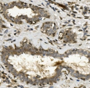 IHC staining of FFPE human breast cancer with TEAD2 antibody. HIER: boil tissue sections in pH8 EDTA for 20 min and allow to cool before testing.
