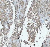 IHC staining of FFPE human bladder urothelial carcinoma tissue with TLN1 antibody. HIER: boil tissue sections in pH8 EDTA for 20 min and allow to cool before testing.