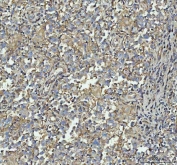 IHC staining of FFPE human testicular germ cell tumor tissue with TLN1 antibody. HIER: boil tissue sections in pH8 EDTA for 20 min and allow to cool before testing.