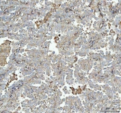 IHC staining of FFPE human lung cancer tissue with TLN1 antibody. HIER: boil tissue sections in pH8 EDTA for 20 min and allow to cool before testing.