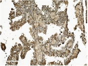 IHC staining of FFPE human renal cancer tissue with TLN1 antibody. HIER: boil tissue sections in pH8 EDTA for 20 min and allow to cool before testing.