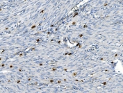 IHC staining of FFPE human endometrial carcinoma with TNFRSF8 antibody. HIER: boil tissue sections in pH8 EDTA for 20 min and allow to cool before testing.