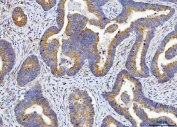 IHC staining of FFPE human rectal cancer tissue with TUBB1 antibody. HIER: boil tissue sections in pH8 EDTA for 20 min and allow to cool before testing.
